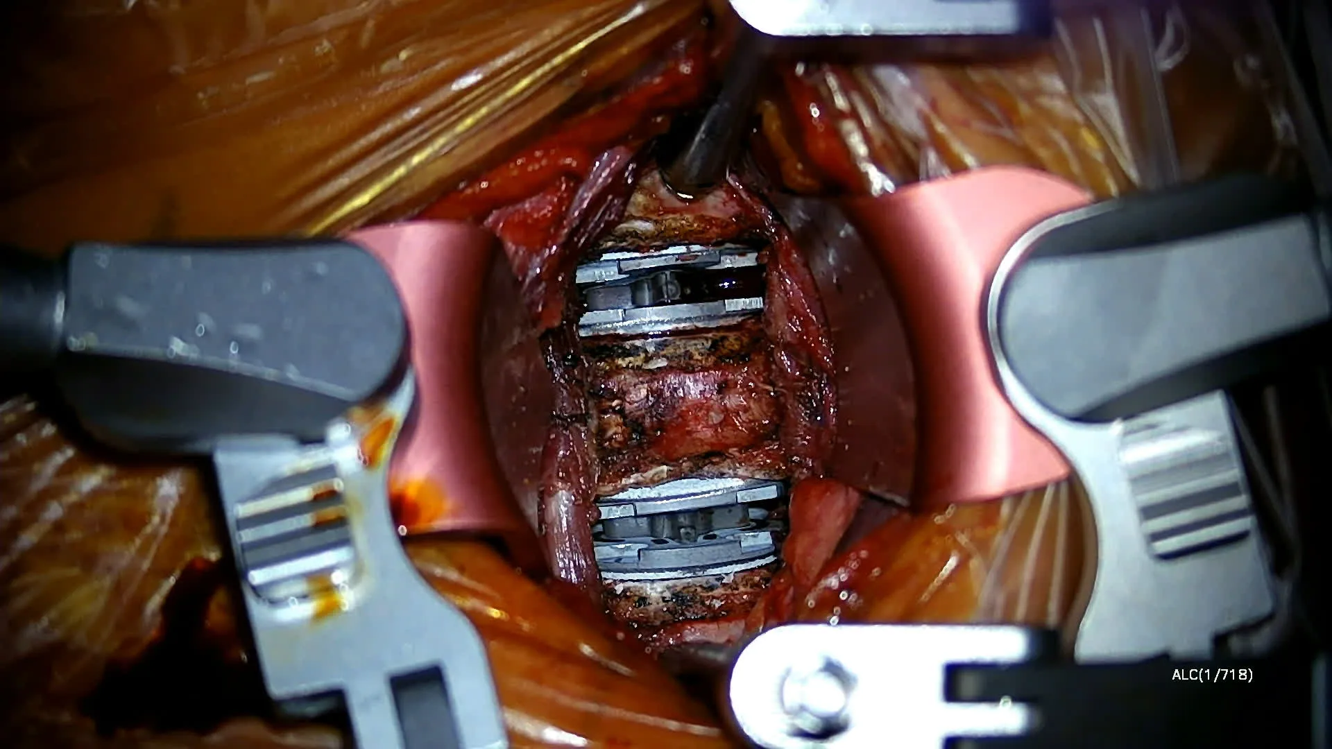Two-level cervical arthroplasty X-ray