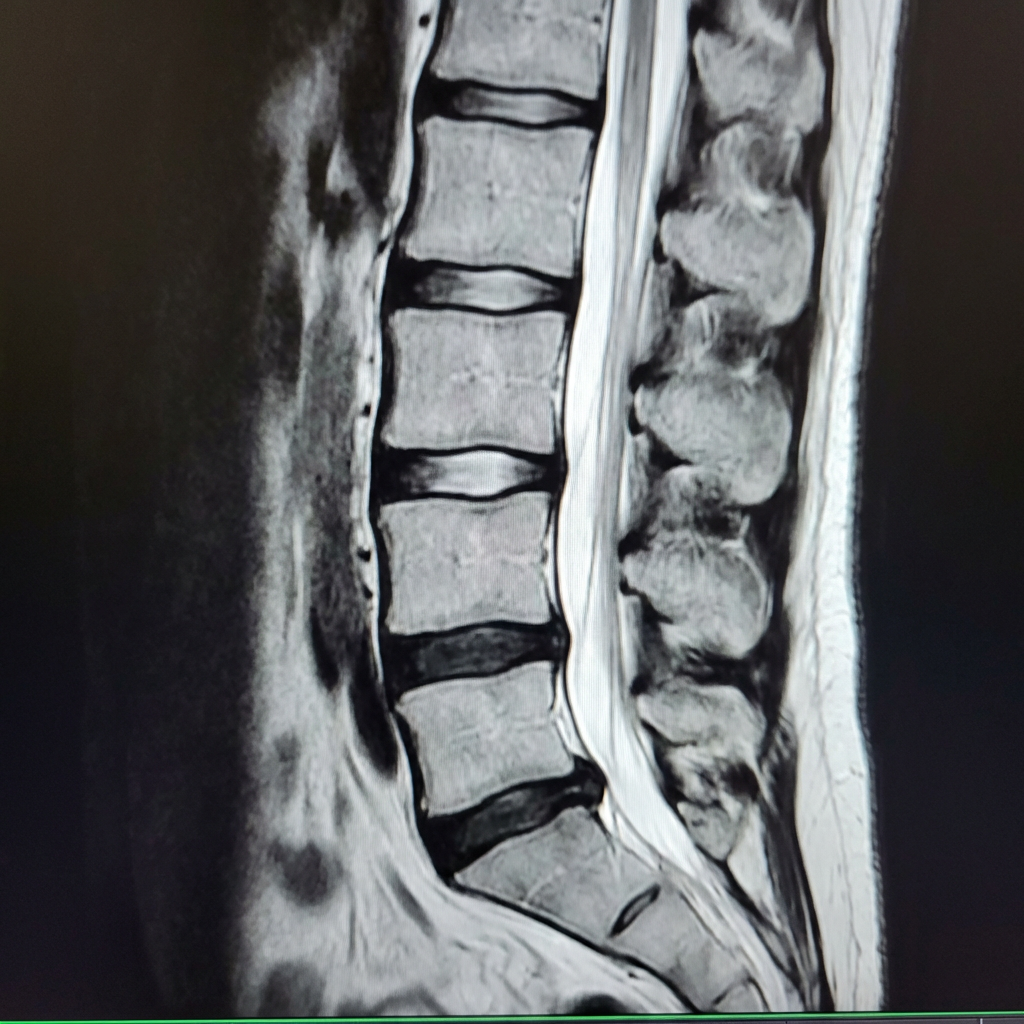 Subject B MRI